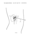 FLOW DIRECTED HEATING OF NERVOUS STRUCTURES diagram and image