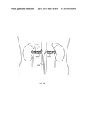 FLOW DIRECTED HEATING OF NERVOUS STRUCTURES diagram and image