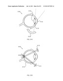 FLOW DIRECTED HEATING OF NERVOUS STRUCTURES diagram and image