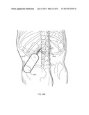 FLOW DIRECTED HEATING OF NERVOUS STRUCTURES diagram and image