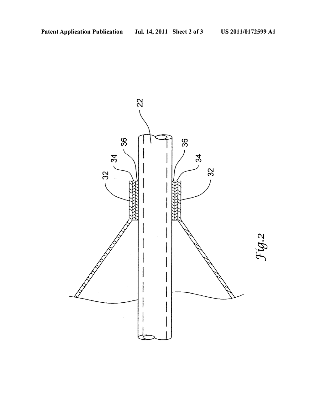 CATHETER HAVING AN IMPROVED BALLOON-TO-CATHETER BOND - diagram, schematic, and image 03