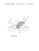 DRAINAGE DEVICE FOR TREATING WOUNDS USING A REDUCED PRESSURE diagram and image