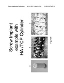 METHOD OF DELIVERING A BIPHOSPHONATE AND/OR STRONTIUM RANELATE BELOW THE     SURFACE OF A BONE diagram and image