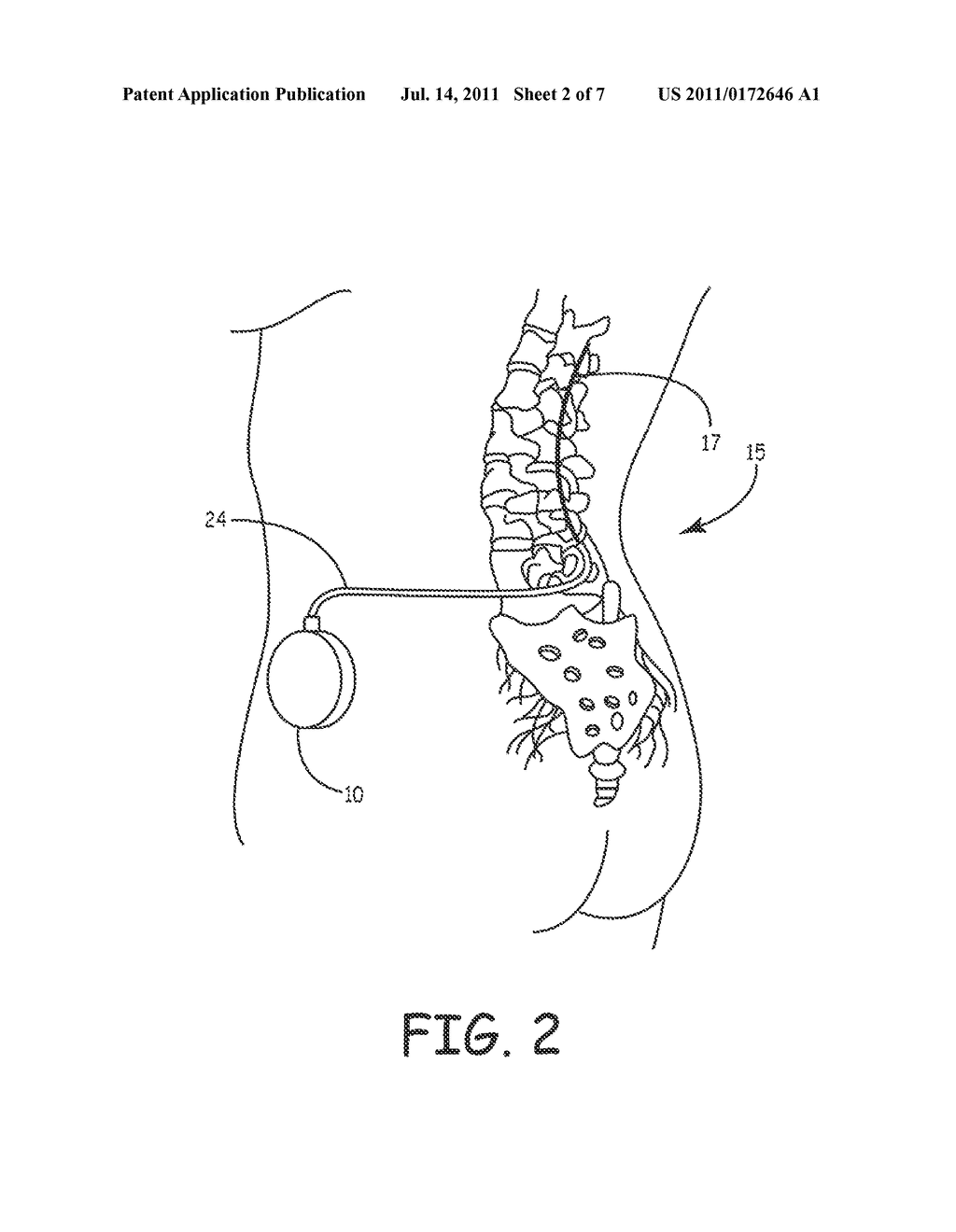 MULTI-MATERIAL SINGLE-PIECE ACTUATOR MEMBER FOR MINIATURE RECIPROCATING     PISTON PUMP IN MEDICAL APPLICATIONS - diagram, schematic, and image 03