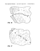 METHOD AND SYSTEM FOR MODIFYING EYE TISSUE AND INTRAOCULAR LENSES diagram and image