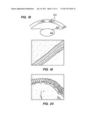 METHOD AND SYSTEM FOR MODIFYING EYE TISSUE AND INTRAOCULAR LENSES diagram and image