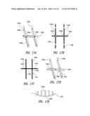 MEDICAL DEVICE FOR USE IN BODILY LUMENS, FOR EXAMPLE AN ATRIUM diagram and image