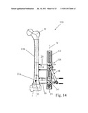 ORTHOPAEDIC DEVICE FOR CORRECTING DEFORMITIES OF LONG BONES diagram and image