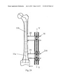 ORTHOPAEDIC DEVICE FOR CORRECTING DEFORMITIES OF LONG BONES diagram and image