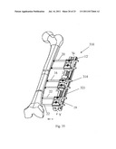 ORTHOPAEDIC DEVICE FOR CORRECTING DEFORMITIES OF LONG BONES diagram and image