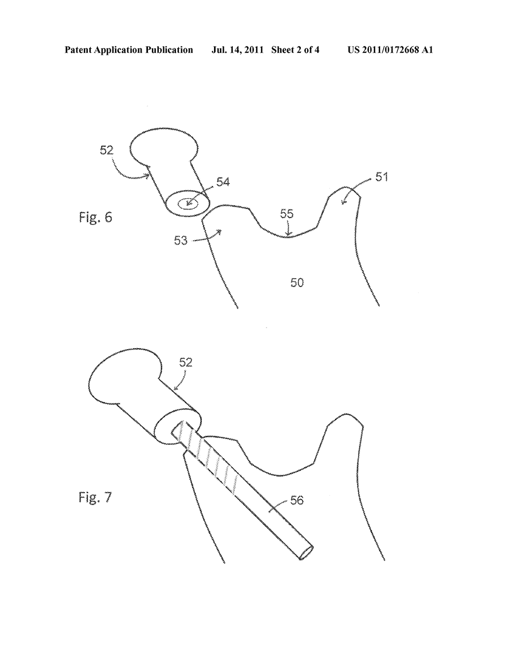 Intramedullary Mandibular Condyle Implants and Method for Application of     the Same - diagram, schematic, and image 03