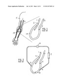 HEMODIALYSIS ARTERIO-VENOUS GRAFT WITH A RING-LIKE DIAMETER-ADJUSTABLE     DEVICE diagram and image