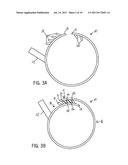 HEMODIALYSIS ARTERIO-VENOUS GRAFT WITH A RING-LIKE DIAMETER-ADJUSTABLE     DEVICE diagram and image