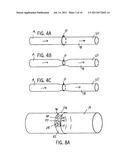 HEMODIALYSIS ARTERIO-VENOUS GRAFT WITH A RING-LIKE DIAMETER-ADJUSTABLE     DEVICE diagram and image