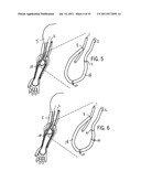 HEMODIALYSIS ARTERIO-VENOUS GRAFT WITH A RING-LIKE DIAMETER-ADJUSTABLE     DEVICE diagram and image