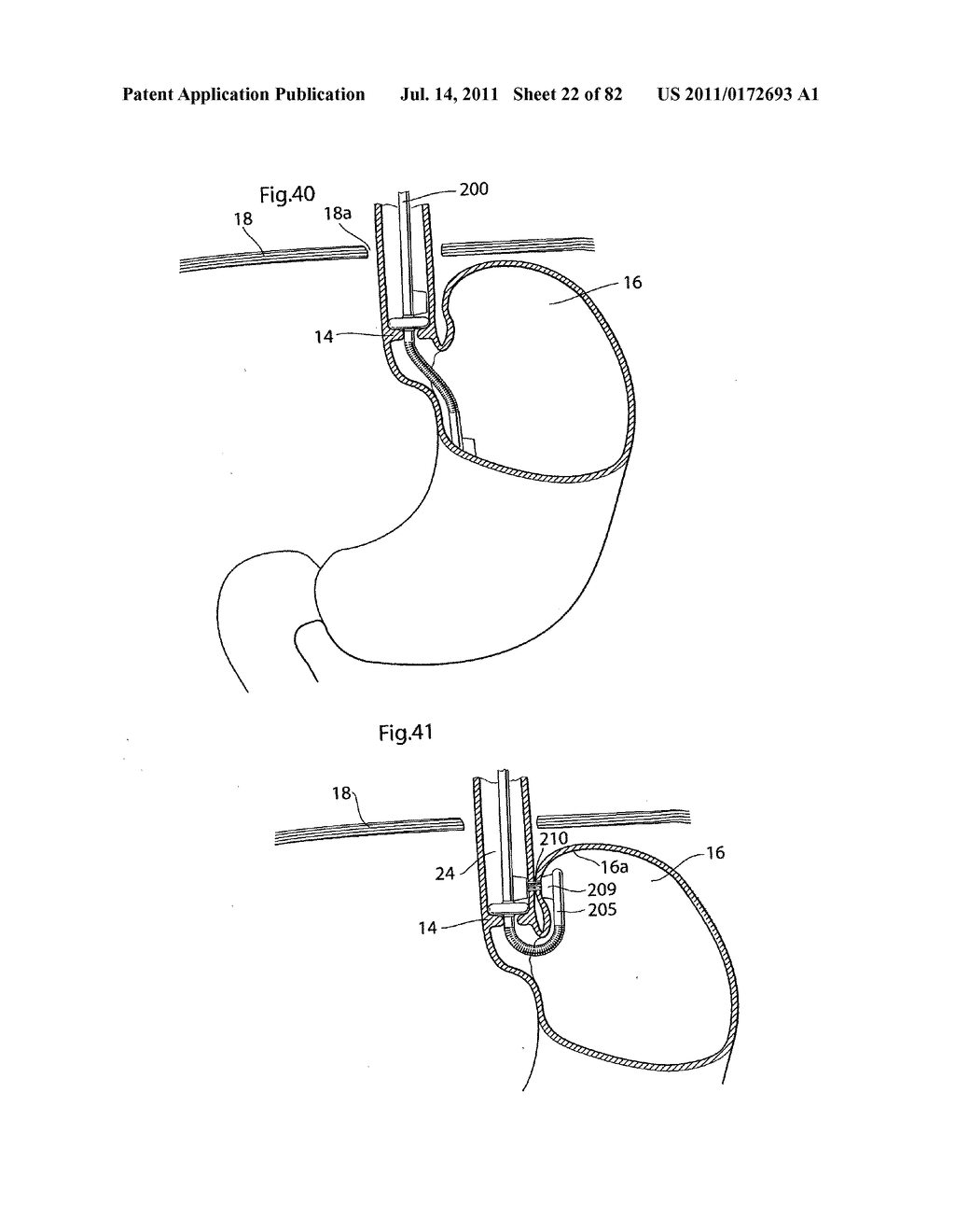 APPARATUS AND METHOD FOR TREATING OBESITY - diagram, schematic, and image 23