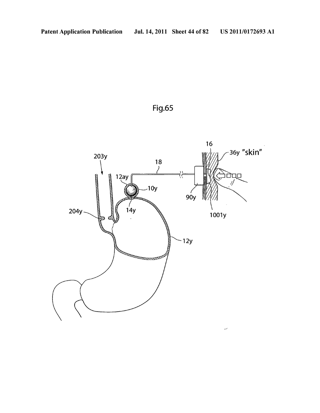 APPARATUS AND METHOD FOR TREATING OBESITY - diagram, schematic, and image 45