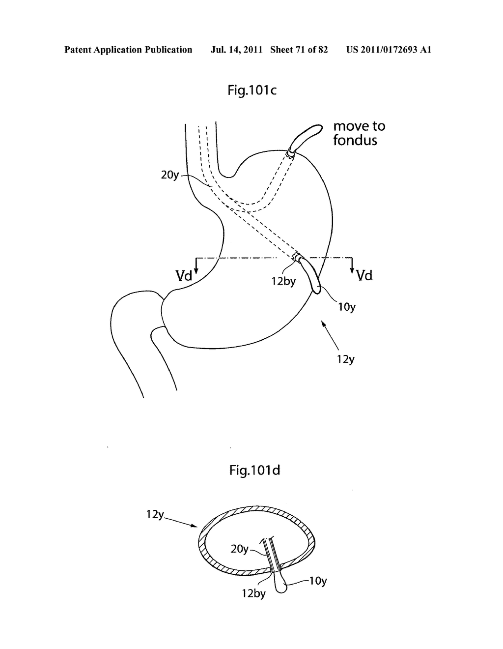 APPARATUS AND METHOD FOR TREATING OBESITY - diagram, schematic, and image 72