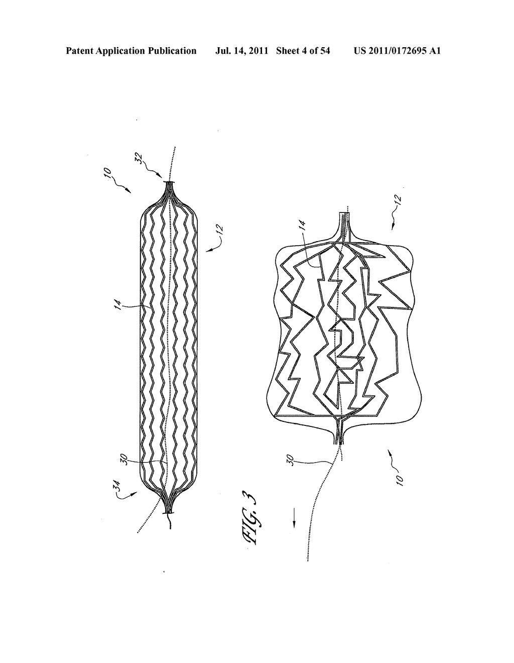 METHOD AND APPARATUS FOR IMPLANTING AN OCCLUSIVE STRUCTURE - diagram, schematic, and image 05