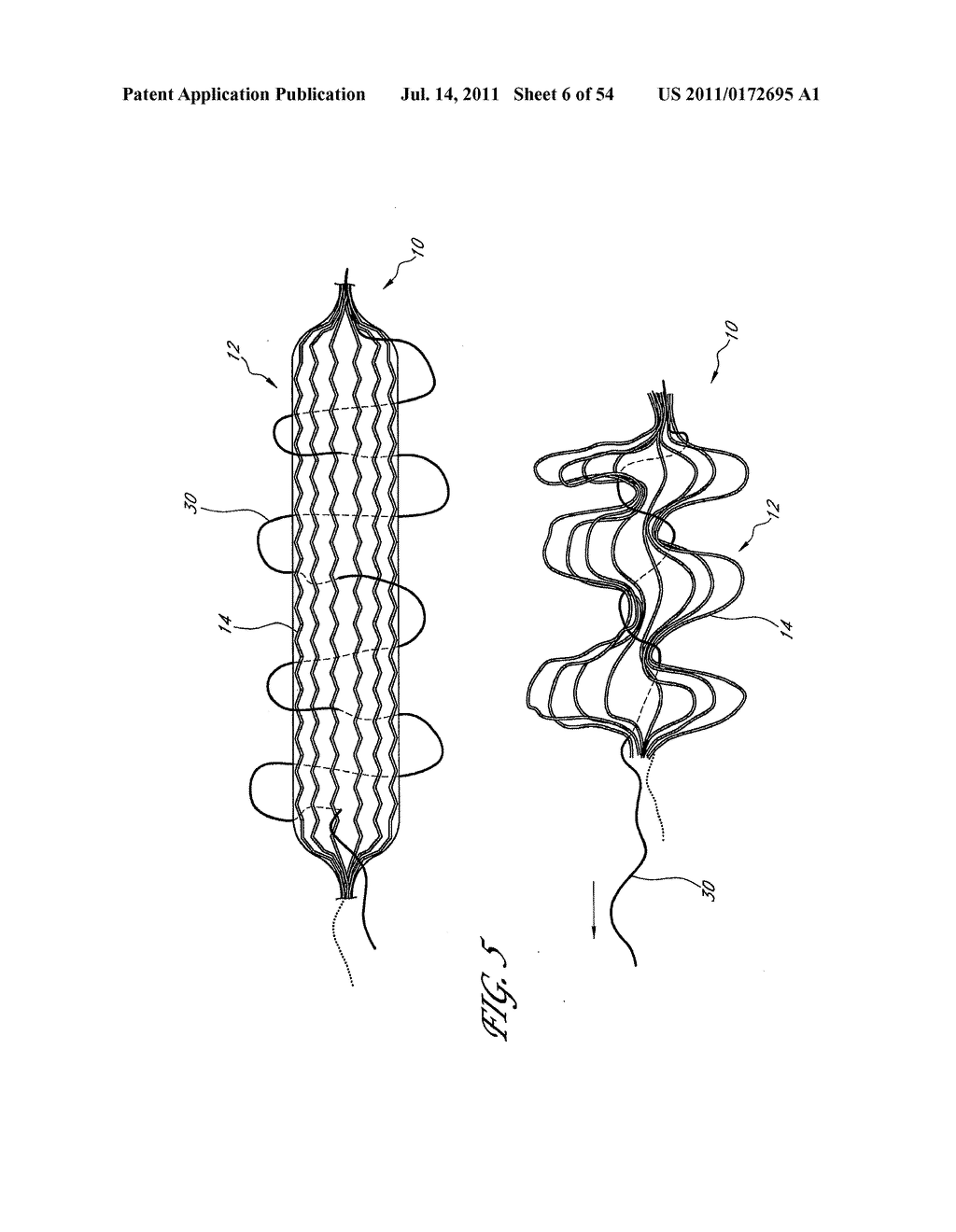 METHOD AND APPARATUS FOR IMPLANTING AN OCCLUSIVE STRUCTURE - diagram, schematic, and image 07