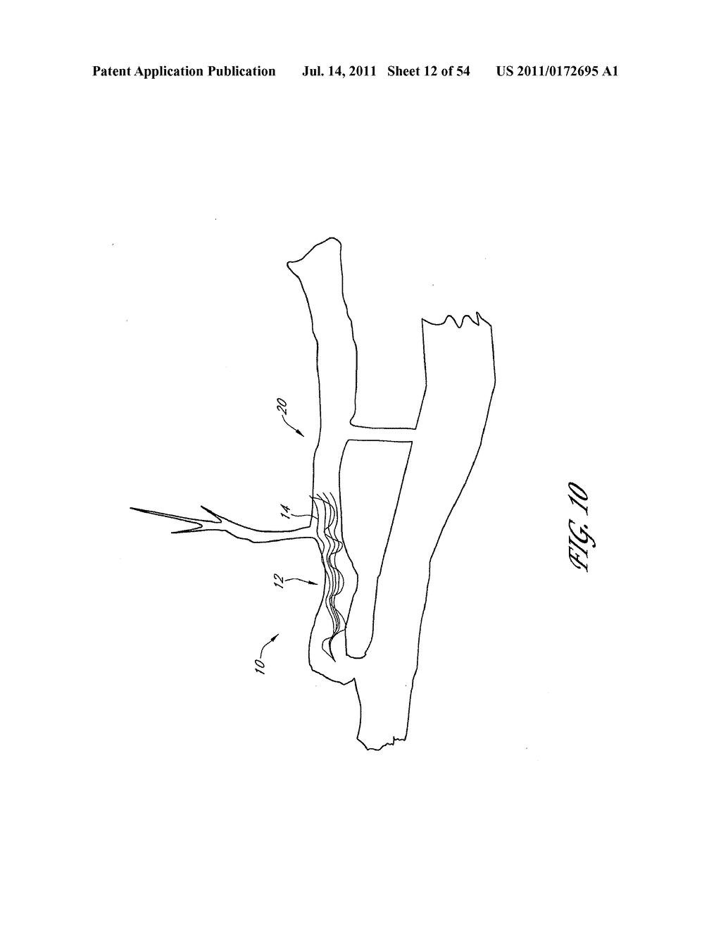 METHOD AND APPARATUS FOR IMPLANTING AN OCCLUSIVE STRUCTURE - diagram, schematic, and image 13