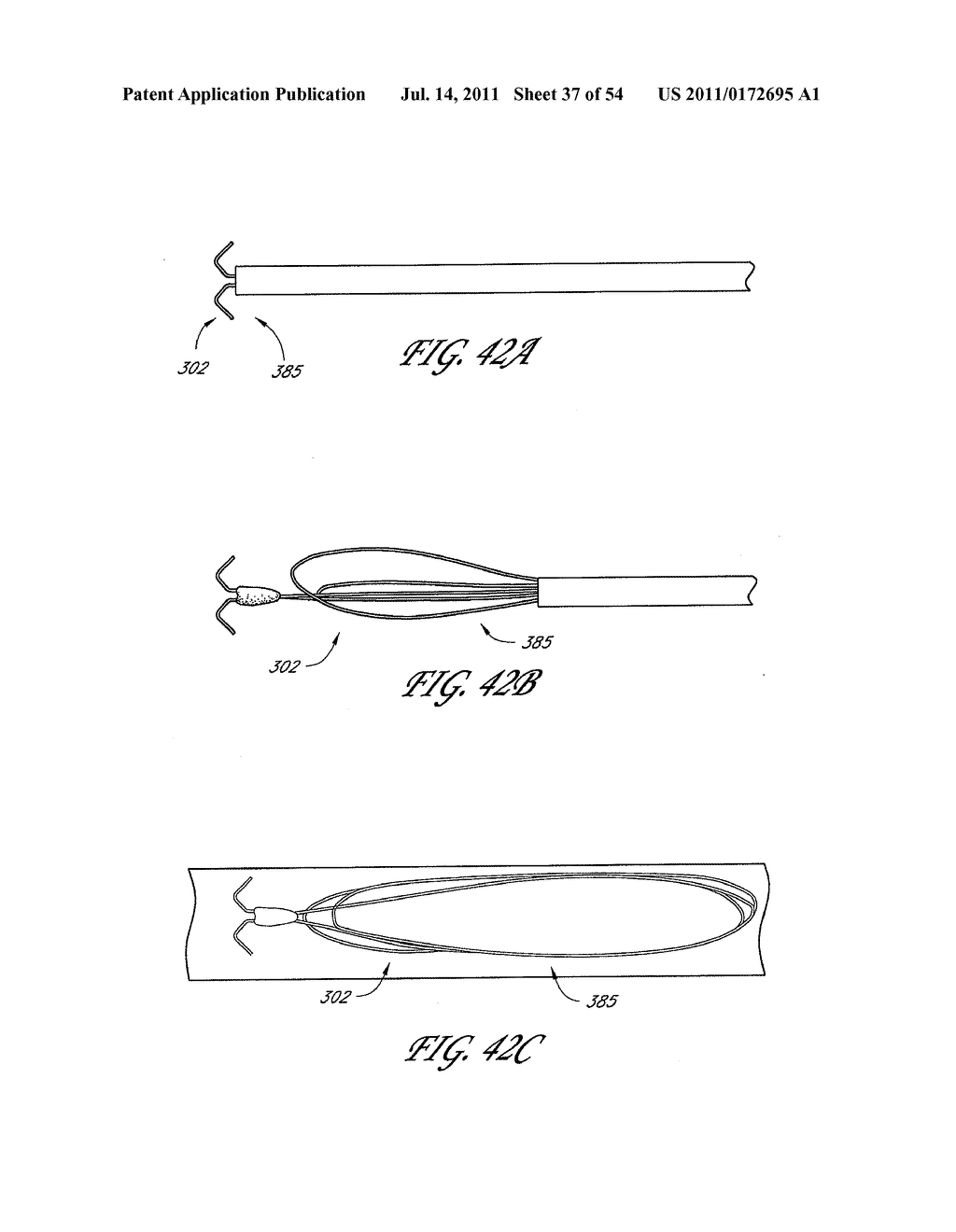 METHOD AND APPARATUS FOR IMPLANTING AN OCCLUSIVE STRUCTURE - diagram, schematic, and image 38