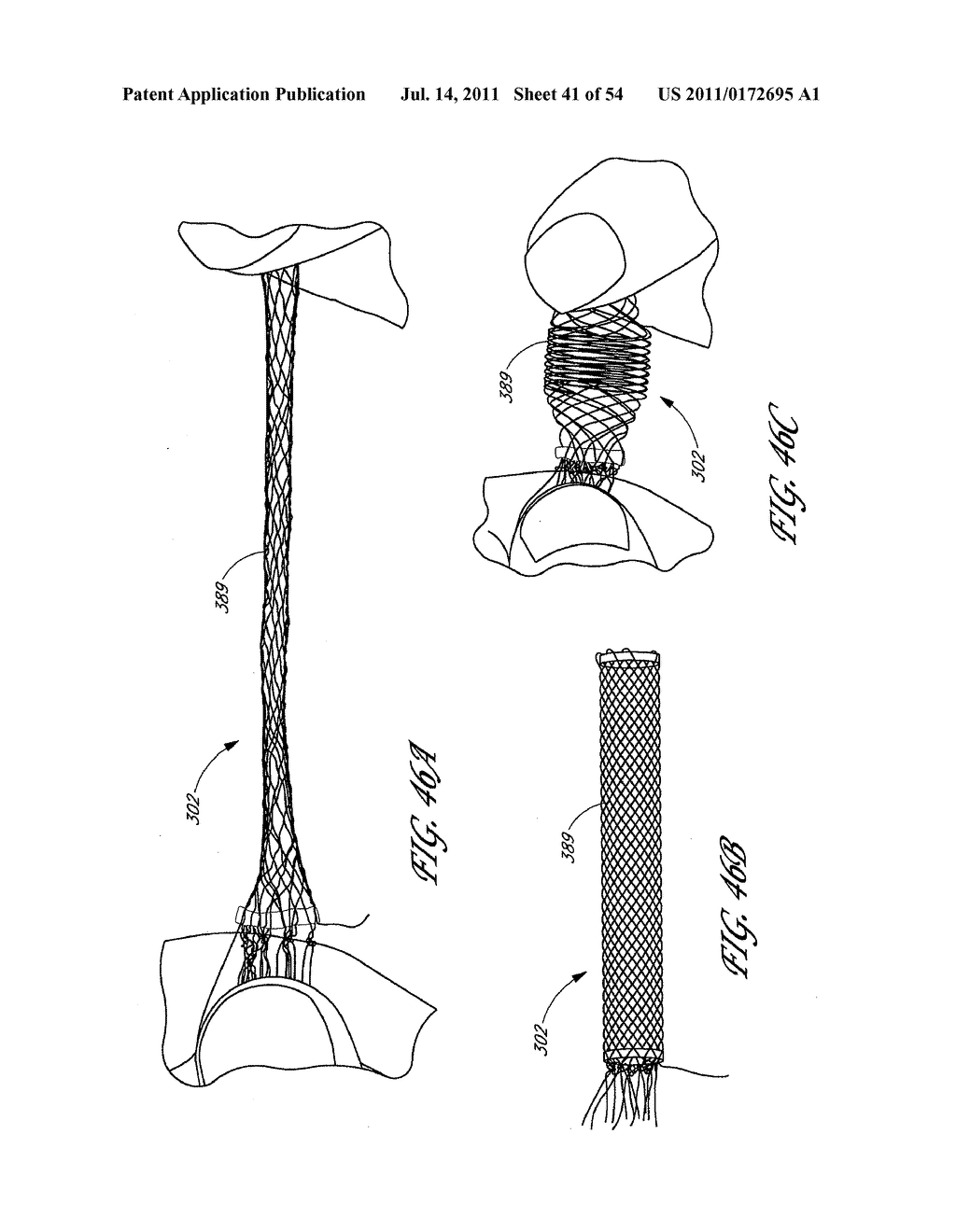 METHOD AND APPARATUS FOR IMPLANTING AN OCCLUSIVE STRUCTURE - diagram, schematic, and image 42