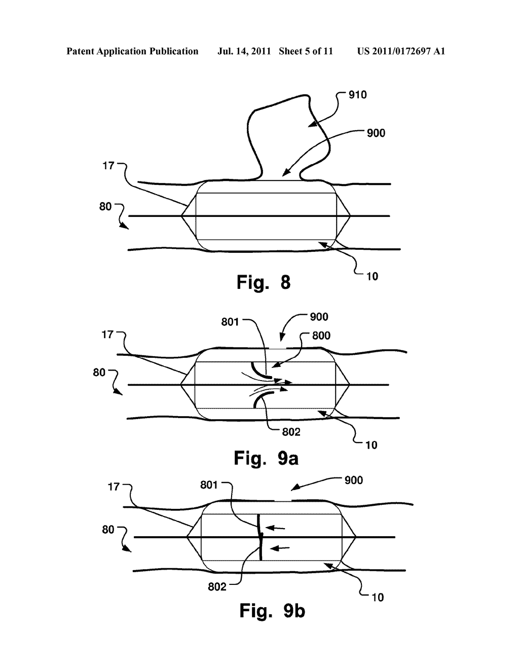 Medical Device, Method And System For Temporary Occlusion Of An Opening In     A Lumen Of A Body - diagram, schematic, and image 06