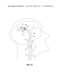 SYSTEM AND METHOD FOR TREATING ISCHEMIC STROKE diagram and image