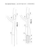 SYSTEM AND METHOD FOR TREATING ISCHEMIC STROKE diagram and image