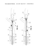 SYSTEM AND METHOD FOR TREATING ISCHEMIC STROKE diagram and image