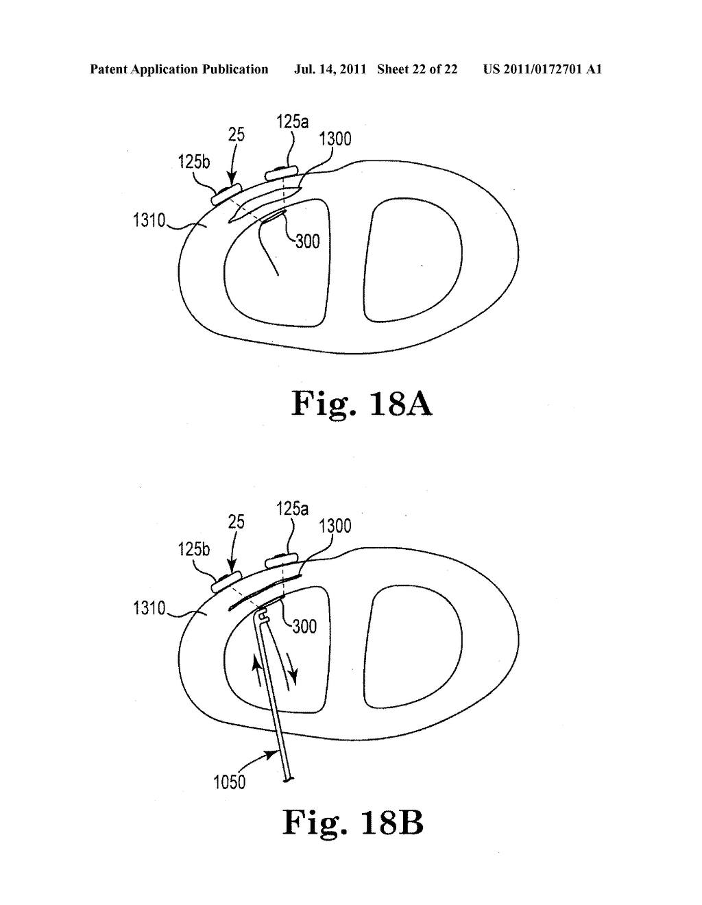 INTERVERTEBRAL DISC ANNULUS REPAIR SYSTEM AND METHOD - diagram, schematic, and image 23