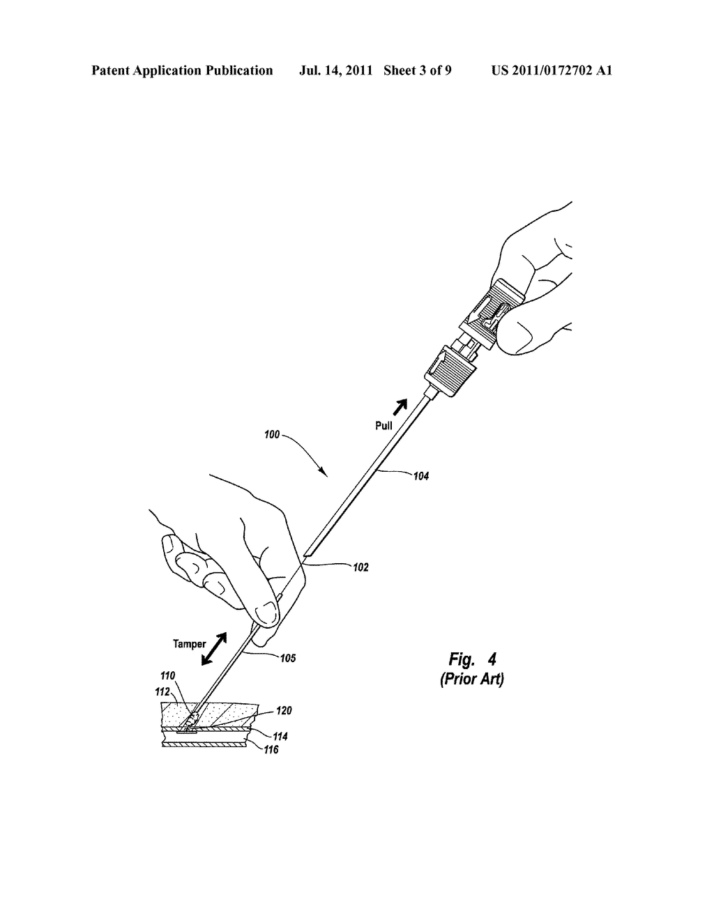 TISSUE PUNCTURE CLOSURE DEVICE WITH AUTOMATIC TAMPING - diagram, schematic, and image 04