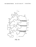 METHODS AND SYSTEMS FOR INCREASING THE BENDING STIFFNESS OF A SPINAL     SEGMENT WITH ELONGATION LIMIT diagram and image