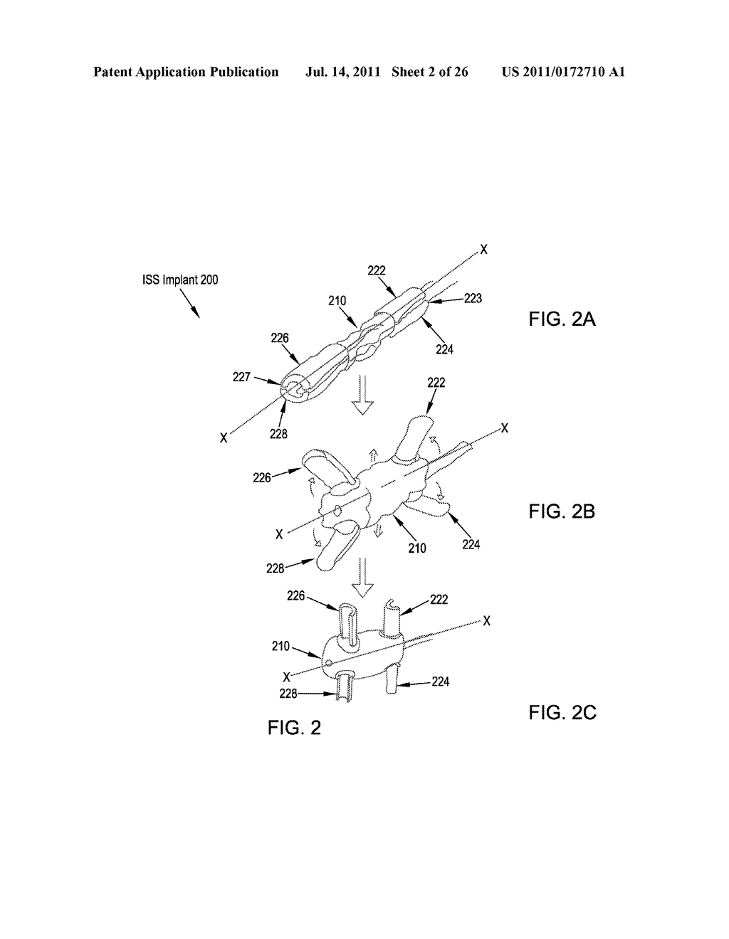 MINIMALLY INVASIVE INTERSPINOUS PROCESS SPACER IMPLANTS AND METHODS - diagram, schematic, and image 03