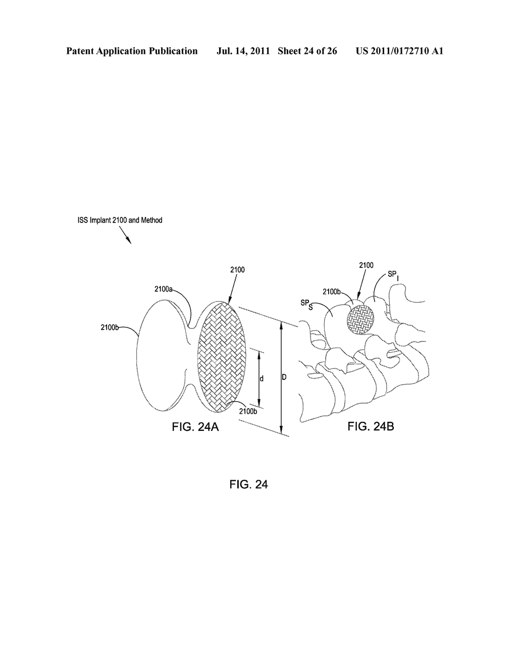 MINIMALLY INVASIVE INTERSPINOUS PROCESS SPACER IMPLANTS AND METHODS - diagram, schematic, and image 25