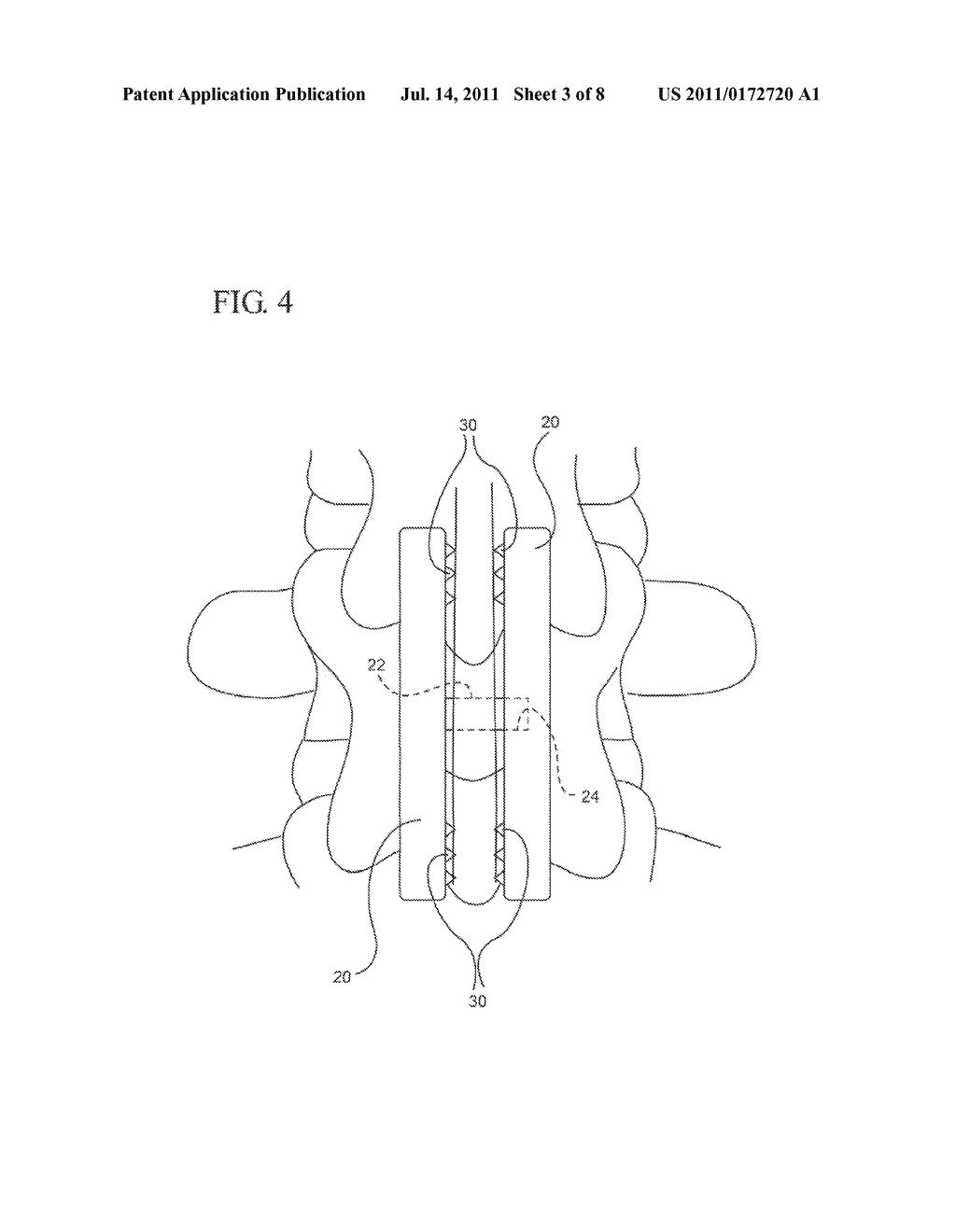 ARTICULATING INTERSPINOUS PROCESS CLAMP - diagram, schematic, and image 04