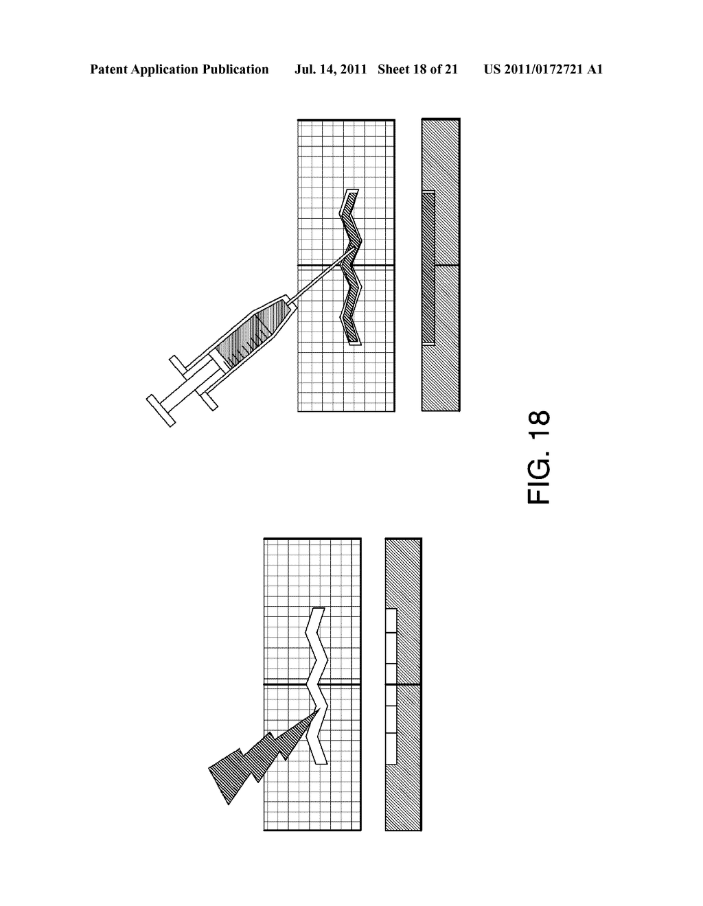 ORTHOPEDIC IMPLANTS FOR USE WITH PRECISION BONE RESURFACING     INSTRUMENTATION - diagram, schematic, and image 19