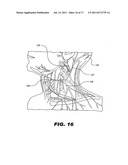 IMPLANTABLE STIMULATOR diagram and image