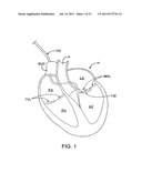 DELIVERY DEVICES AND METHODS FOR HEART VALVE REPAIR diagram and image