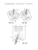 MINIMALLY INVASIVE, DIRECT DELIVERY METHODS FOR IMPLANTING OBESITY     TREATMENT DEVICES diagram and image