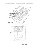 MINIMALLY INVASIVE, DIRECT DELIVERY METHODS FOR IMPLANTING OBESITY     TREATMENT DEVICES diagram and image