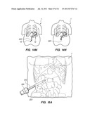 MINIMALLY INVASIVE, DIRECT DELIVERY METHODS FOR IMPLANTING OBESITY     TREATMENT DEVICES diagram and image