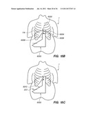 MINIMALLY INVASIVE, DIRECT DELIVERY METHODS FOR IMPLANTING OBESITY     TREATMENT DEVICES diagram and image