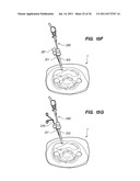 MINIMALLY INVASIVE, DIRECT DELIVERY METHODS FOR IMPLANTING OBESITY     TREATMENT DEVICES diagram and image