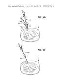 MINIMALLY INVASIVE, DIRECT DELIVERY METHODS FOR IMPLANTING OBESITY     TREATMENT DEVICES diagram and image