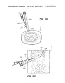 MINIMALLY INVASIVE, DIRECT DELIVERY METHODS FOR IMPLANTING OBESITY     TREATMENT DEVICES diagram and image