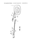 MINIMALLY INVASIVE, DIRECT DELIVERY METHODS FOR IMPLANTING OBESITY     TREATMENT DEVICES diagram and image