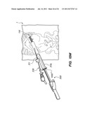 MINIMALLY INVASIVE, DIRECT DELIVERY METHODS FOR IMPLANTING OBESITY     TREATMENT DEVICES diagram and image