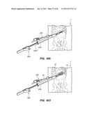 MINIMALLY INVASIVE, DIRECT DELIVERY METHODS FOR IMPLANTING OBESITY     TREATMENT DEVICES diagram and image